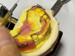 잘 유지되고 조정 가능한 기능으로 주문 제작 된 정형 치아 장치