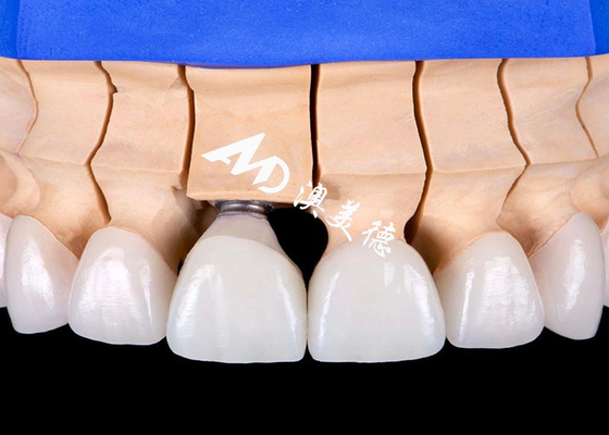 주문 기능성 미용 치아 임플란트 크라운 브리지 online manufacture