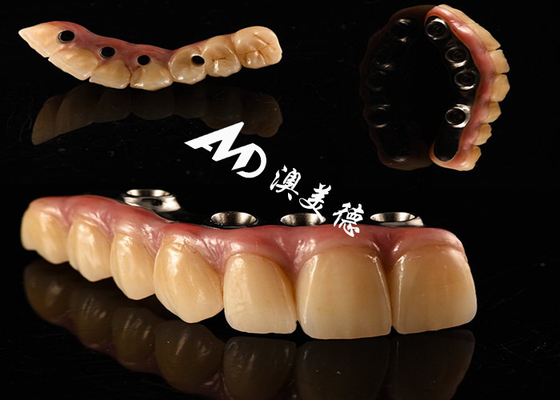 주문 자연스러운 외모의 치아 임플란트 크라운 브릿지 online manufacture