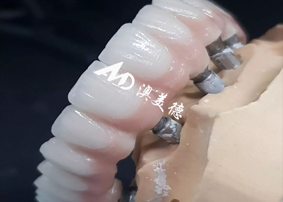 주문 독점적인 고성능 치아 임플란트 크론 브릿지 다양한 크기 online manufacture