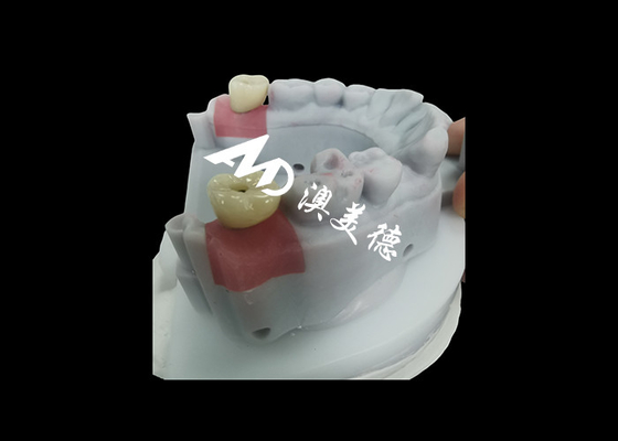 주문 지속 가능한 치아 복원을 위한 티타늄 기둥으로 치아 임플란트 왕관 online manufacture