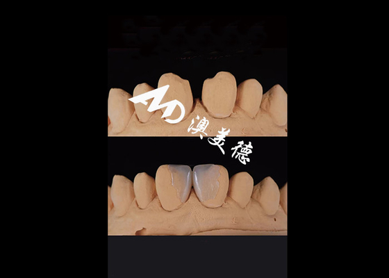 주문 0.3-0.5mm 미적 미화 변경을 위한 초파른 IPS EMAX 포르셀린 장단 online manufacture