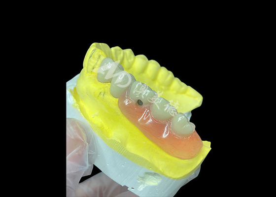 주문 개인화 된 PFM + 제거 가능한 치아 콤보 편안함과 미용에 대한 궁극적인 해결책 online manufacture