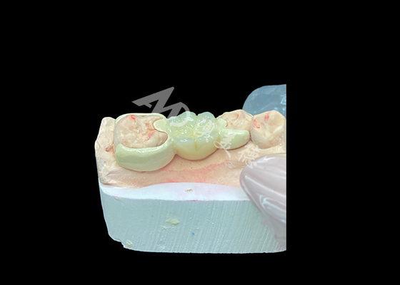 주문 증강 미소 미적 및 생체 호환성을 위해 HPP 결합 된 다리로 지르코니아 크라운 online manufacture