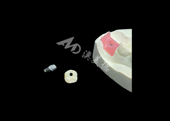주문 장기간 지속 되는 치과 임플란트 왕관 이 회복 치과 의 절차 에 혁명을 일으킨다 online manufacture