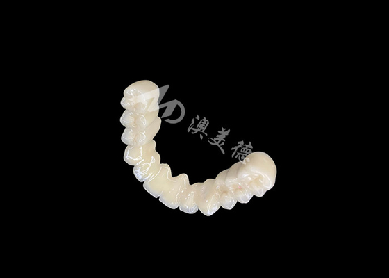 주문 장기간 유지되는 접합 PFM 치과 왕관 다리 우수한 생물 호환성 안전 접합 online manufacture