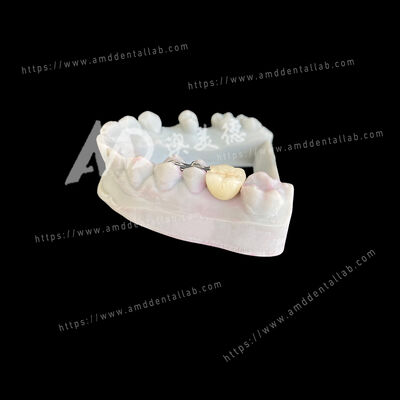 주문 PFM 메릴랜드 브리지 원 폰틱 두 날개 보수적이고 미적 인 해결책 online manufacture