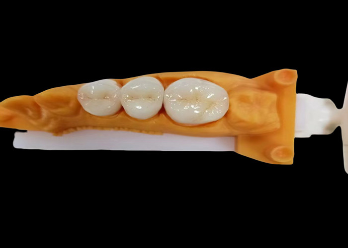 착용 저항성 Zirconia 치아 왕관