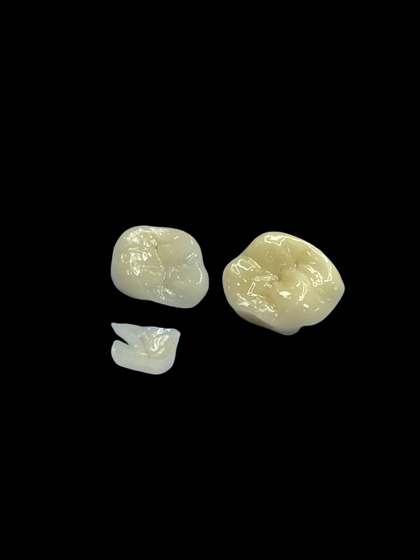 항 알레르기 가 있는 도자기 인레이 치아 수리용 인레이 자연 색상 및 간편 한 유지