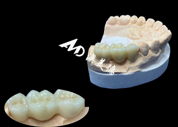 천연 색의 지르코니아 치아 왕관 China Dental Lab의 흠없는 미소를 위해 균열 저항