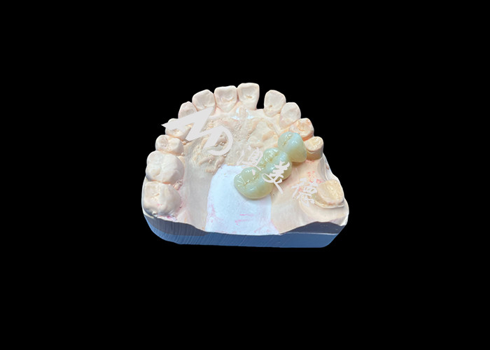 천연 색의 지르코니아 치아 왕관 China Dental Lab의 흠없는 미소를 위해 균열 저항