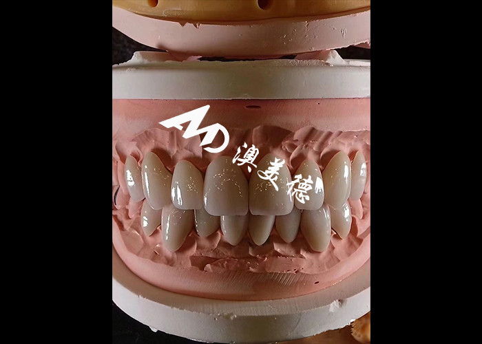 화장품 치과 EMAX 치과 장단 0.3-0.5mm 두께