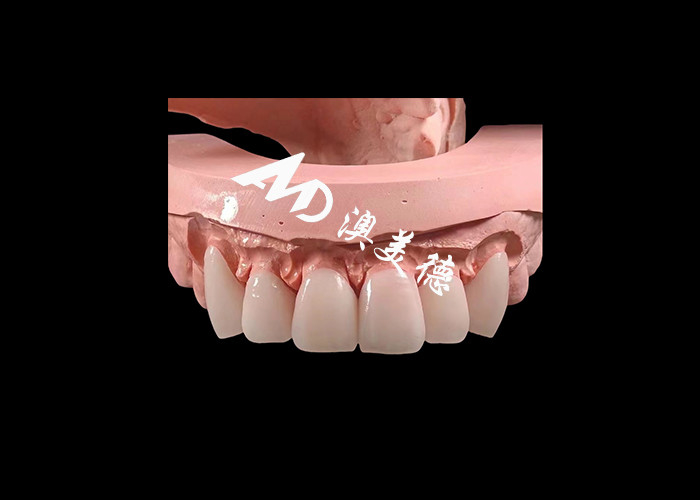 화장품 치과 EMAX 치과 장단 0.3-0.5mm 두께