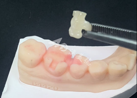 좋은 가격 Emax 세라믹 인레이/온레이 치과 수복물 - 자연 치아 색상 온라인으로