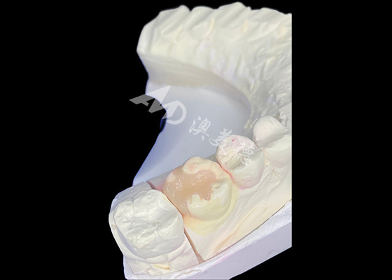 좋은 가격 IPS e.max 영구적인 미적 및 자연스러운 외모 결과를 가진 모자 복원을 위한 세라믹 인레이 및 온레이 온라인으로