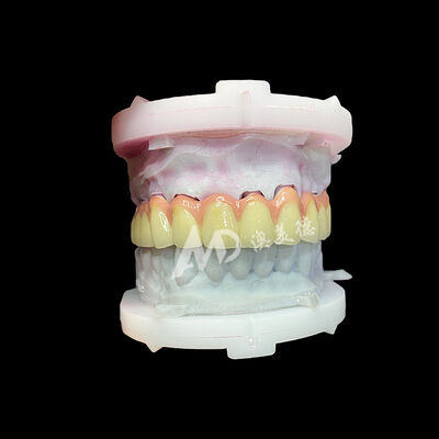 좋은 가격 순수 티타늄 세라믹 왕관 및 다리 내구성 가벼운 미적 복원 온라인으로